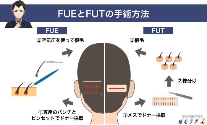 FUEとFUTの手術方法の違い