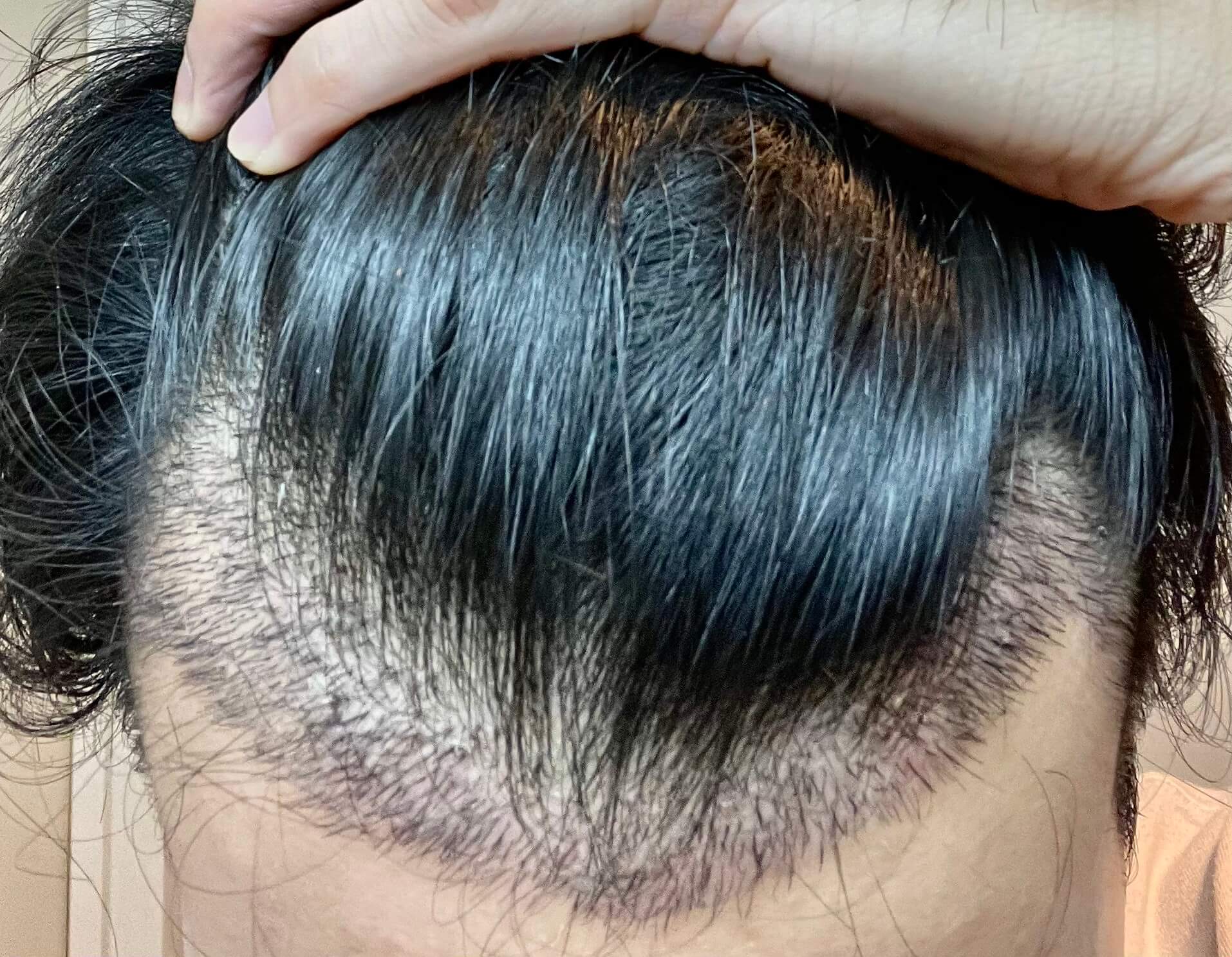 植毛1週間後の写真