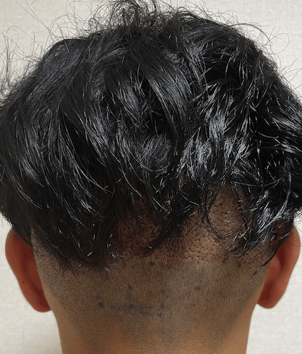 FUE植毛手術直後の後頭部(髪を下ろした状態)