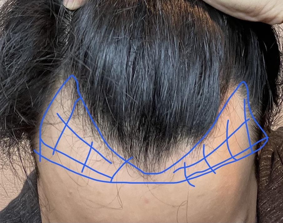 植毛前のデザイン確認イメージ