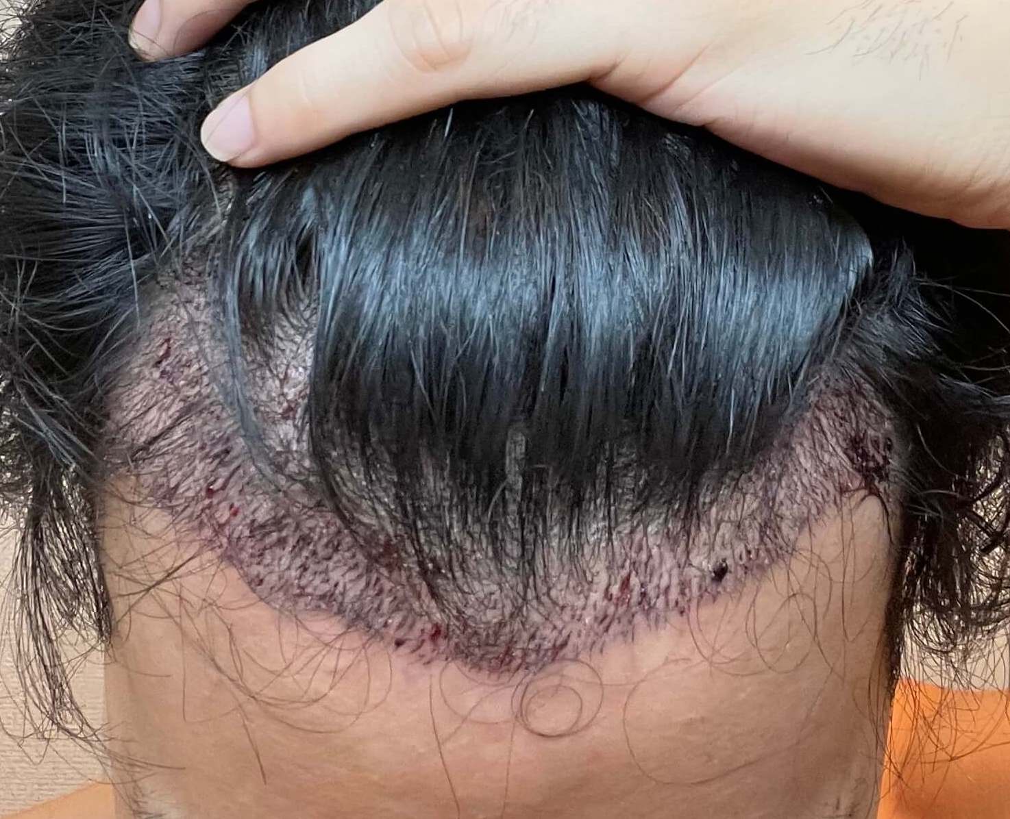 植毛手術直後のM字部分