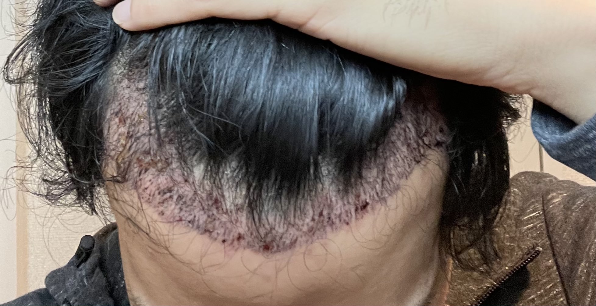 FUE植毛手術翌日のM字部分