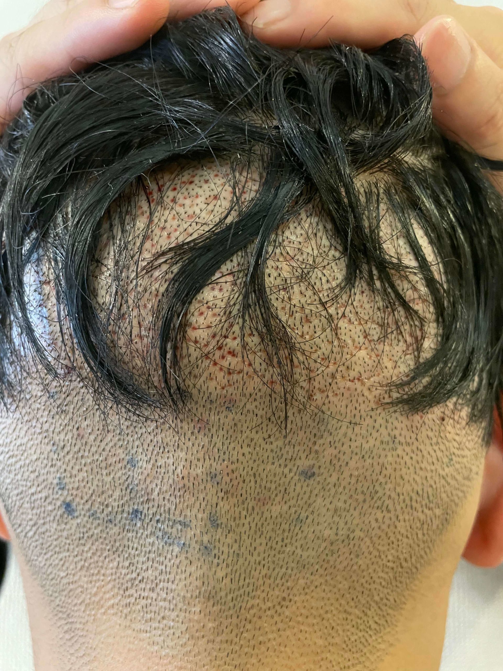 FUE植毛手術翌日の後頭部