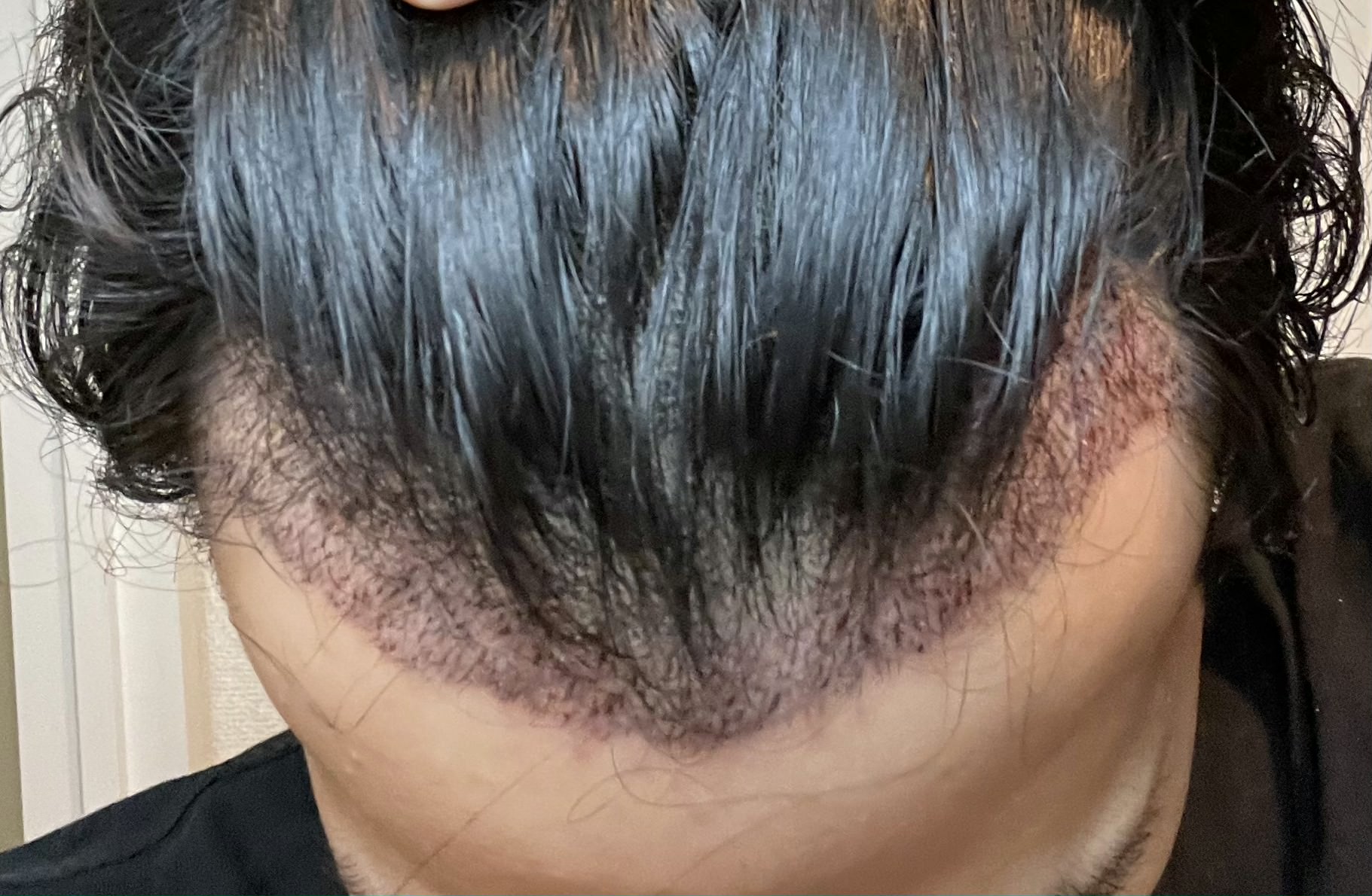 FUE植毛手術翌日のM字部分(かさぶたケアした後)