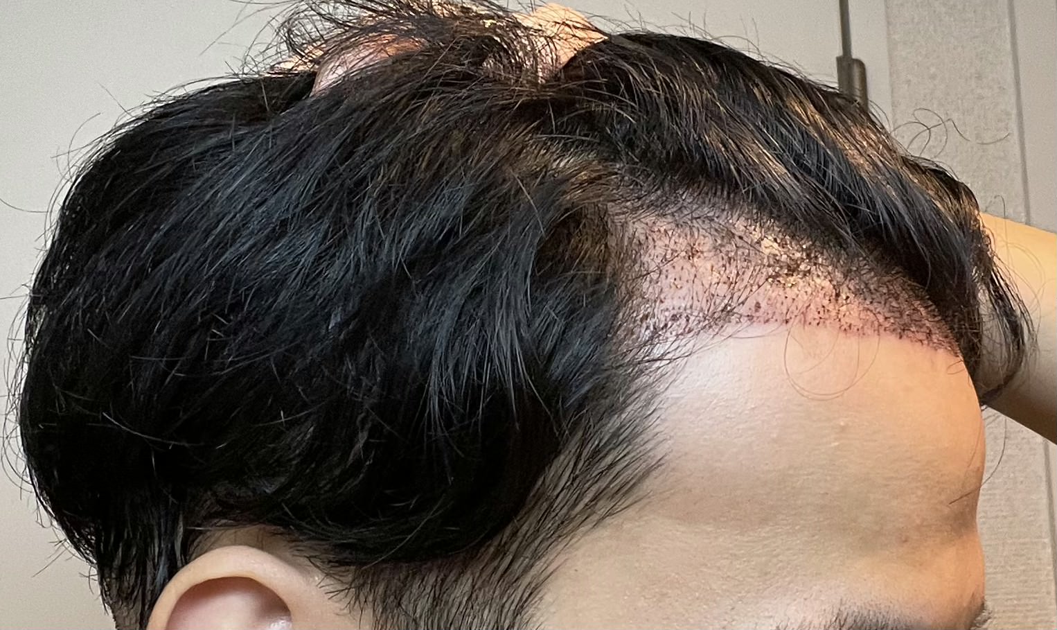 FUE植毛手術翌日のおでこの膨らみ