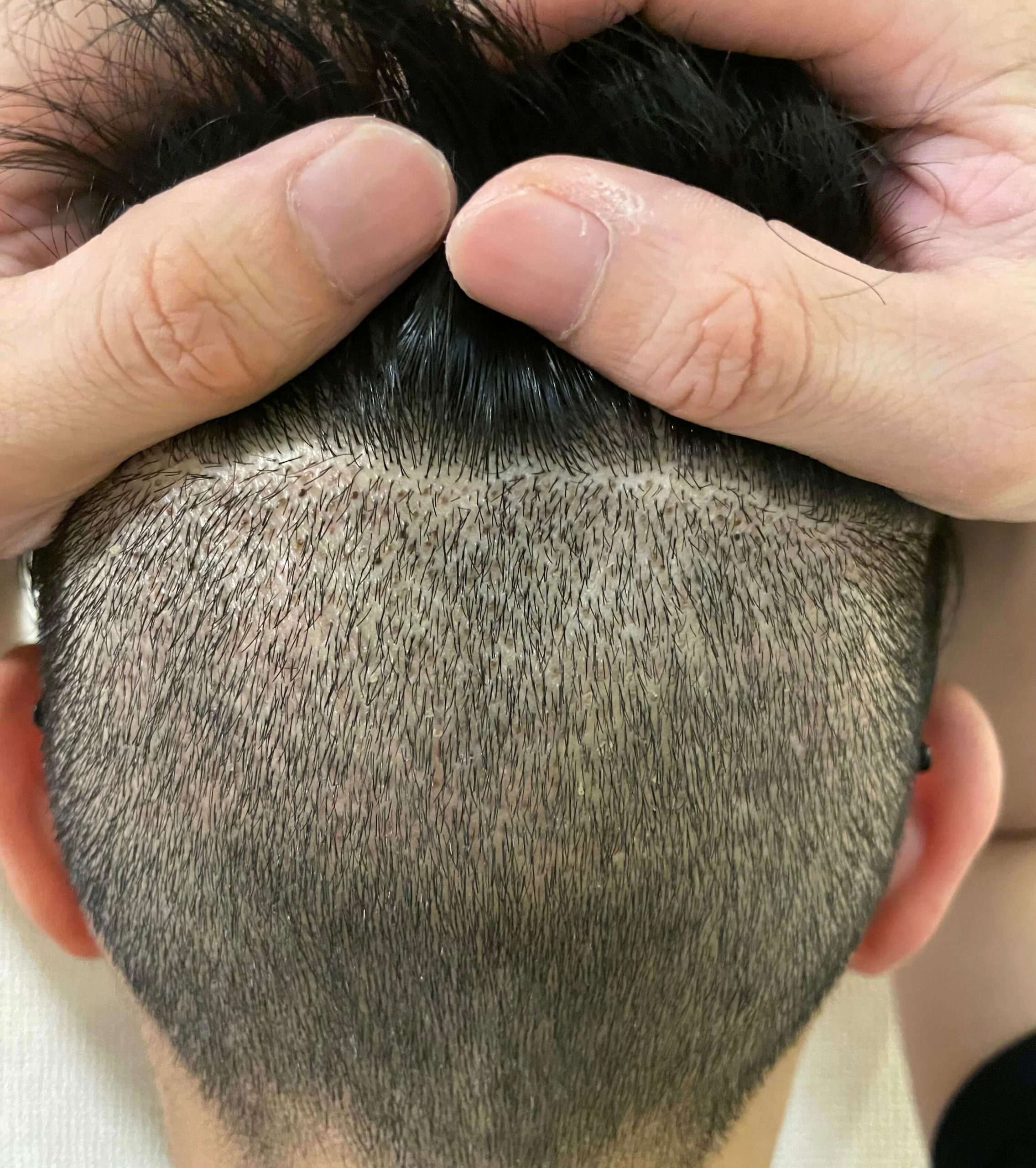 FUE植毛手術から1週間後の後頭部