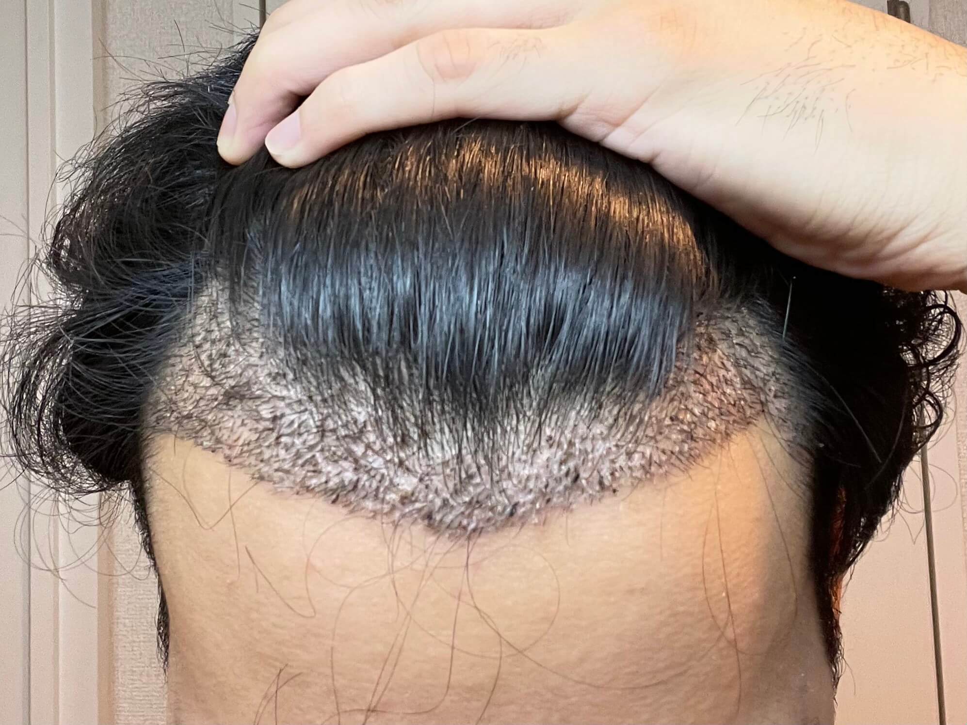 FUE植毛手術から1週間後のM字部分