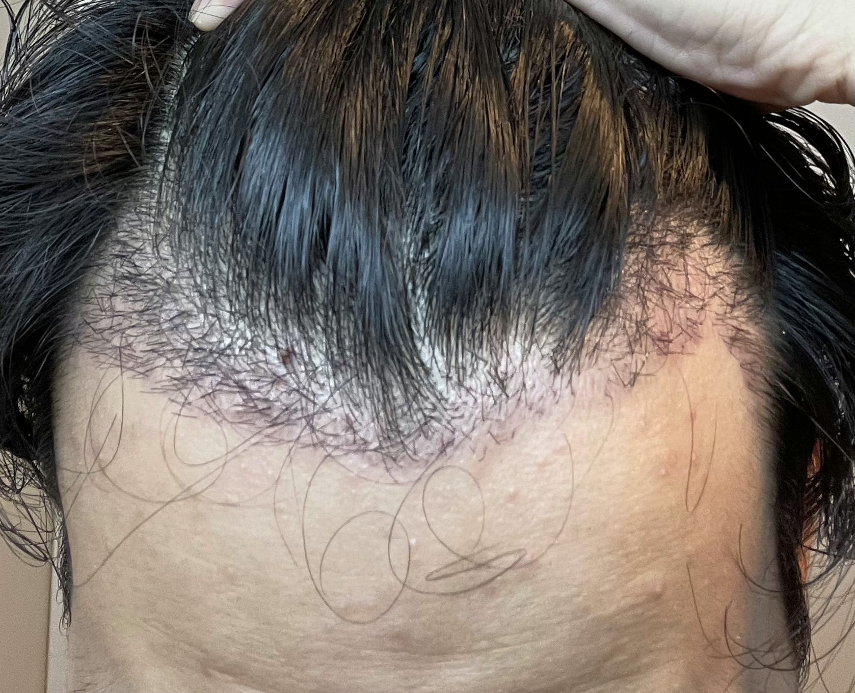FUE植毛手術から2週間後のM字部分