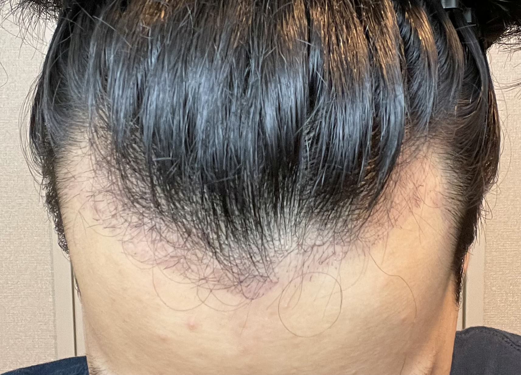 FUE植毛手術から3週間後のM字部分