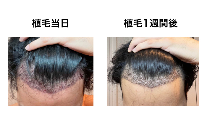FUE植毛手術当日と1週間後の比較(M字)