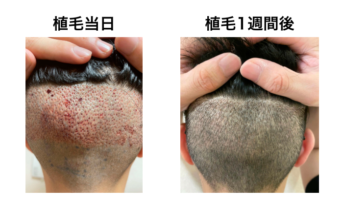 FUE植毛手術当日と1週間後の比較(後頭部)