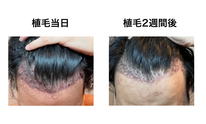 FUE植毛手術当日と2週間後の比較(M字)