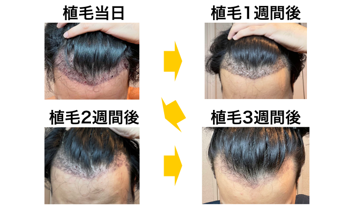FUE植毛手術当日と3週間後の比較(M字)