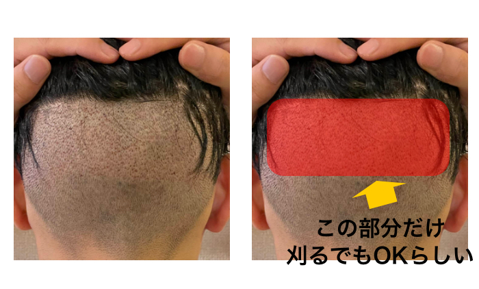 植毛前の後頭部刈り上げ